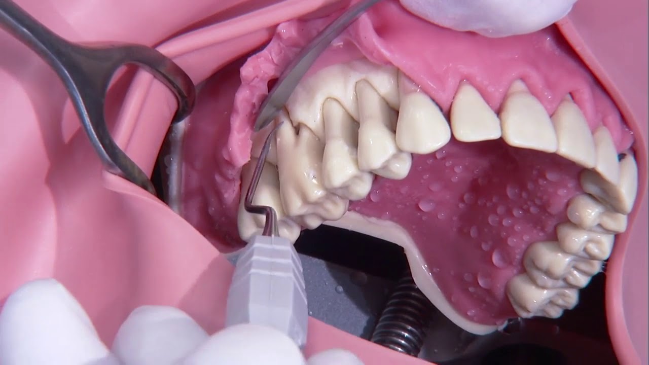 Parodontalechirurgie Zahnarzt In Ungarn Diamant Dent Zahnklinik Youtube