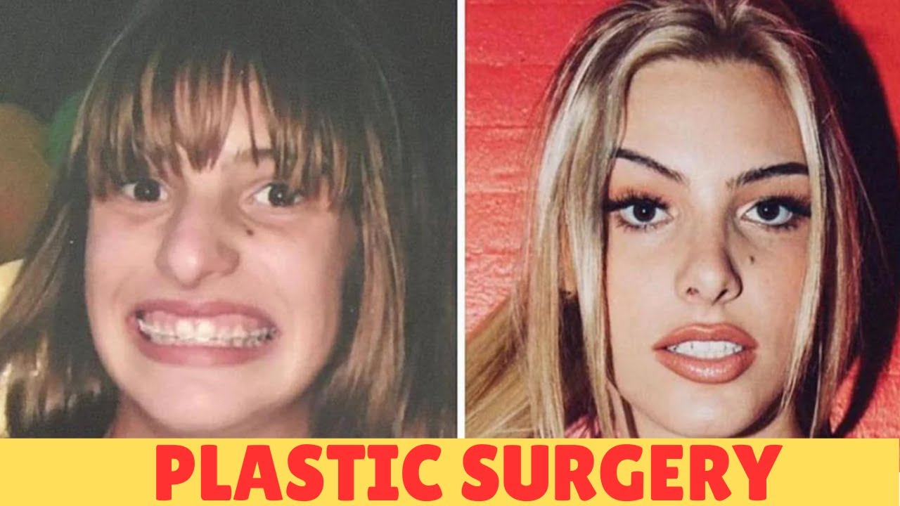 Celebrity Plastic Surgery Disasters What Went Wrong? YouTube