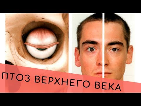 Птоз верхнего века. Упражнения