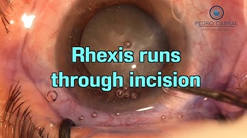 Capsulorhexis runs through incision - By Pedro Cabral Cataract Surgery