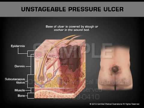 Various Stages of Pressure Ulcers - YouTube