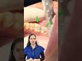 🦷CARIES PROFUNDAS✨ #shortvideo #odontologia #caries #cariesdental #viralvideo #dentista