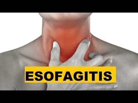 Esofagitis e c GERD | Sistem Pencernaan | GERD