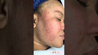 “Peeling Suave para una Piel Fresca y Radiante: Adiós al Brillo” parte 2
