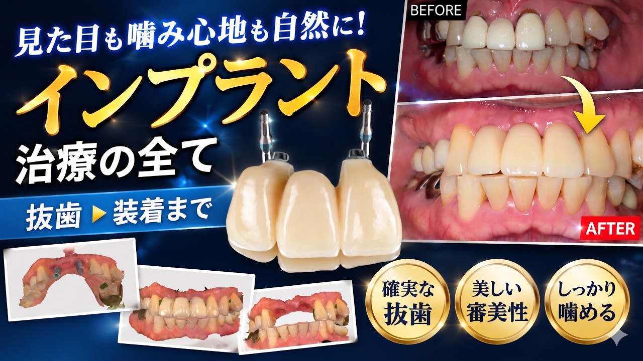 インプラント症例集｜藤原歯科医院｜奈良県大和高田市の歯医者・歯科