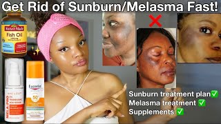 How to Get Rid of Sunburn and Melasma | Full treatment plan for Sunburn and Melasma + Supplements ✅