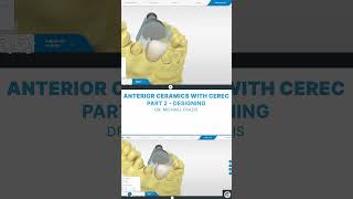Designing Anterior Ceramics With Cerec Expert Tips In 60 Seconds