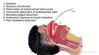 Complications of Nasal Endotracheal Intubation