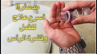 تخلص من مشكلة القمل وقشرة الرأس في يوم واحد فقط للكبار و الصغار