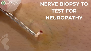 Nerve Biopsy to Test for Neuropathy
