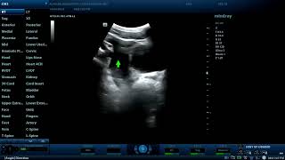 Splenic Trauma With A Laceration - Diagnostic Ultrasound Cases
