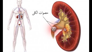 حصوات الكلى والحالب مع د يوسف موسى في جمال الصحة