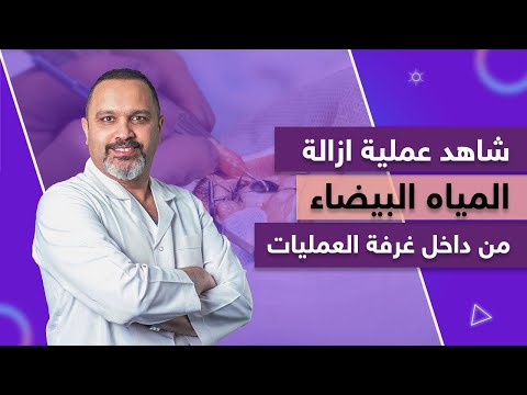 شاهد عملية ازالة المياه البيضاء من داخل غرفة العمليات الدكتور أشرف حسن سليمان