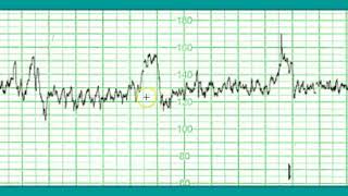 Интерпретация нормальной кардиотокограммы