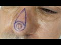 Island Pedicle Flap for Nasal BCC/فلپ آیلند پدیکل برای جراحی سرطان پوستی بینی 