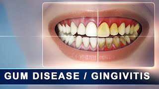 Gingivitis | Treatment of periodontal disease - Scaling and root planing - Tartar