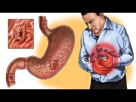 5 Effective Home Remedies For Gastritis