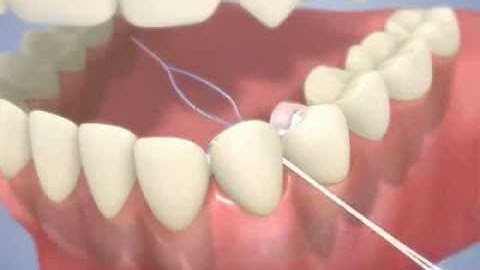 Austin Dental Bridge - Flossing with a Dental Bridge