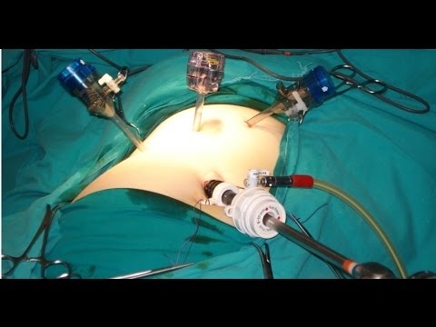 Port Position In Laparoscopy - Baseball Diamond Concept By Dr R K Mishra