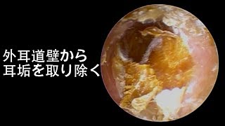 Relaxing Ear Cleaning Earwax Removal - Earwax block his hearing