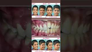 Bracing for a Brighter Tomorrow: Smile Transformation Journey ?✨ braces journey transformation