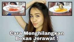 Cara Menghilangkan Bekas Jerawat Dengan Cepat ! | Savira Millenita  - Duration: 4:35. 