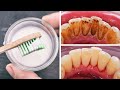 Home remedy to remove dental plaque  tarter to prevent cavities
