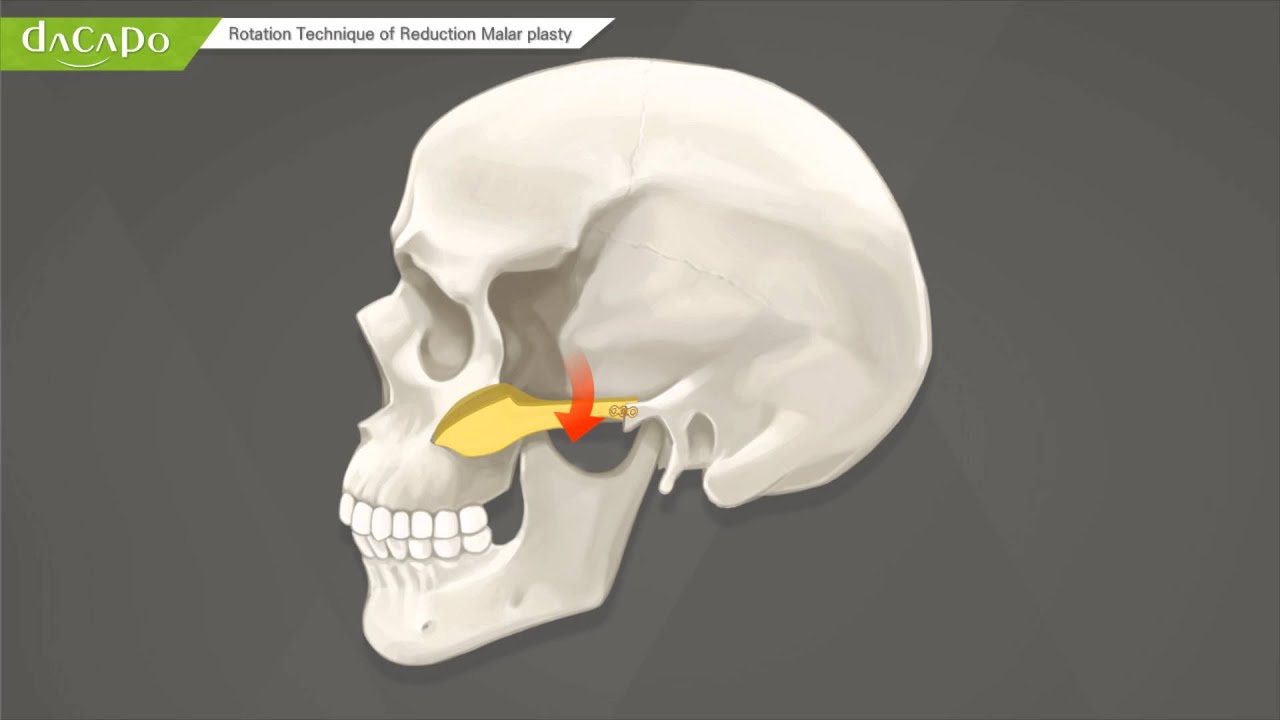 Reduction zygomaplasty,malar plastyDacapo dental clinic YouTube