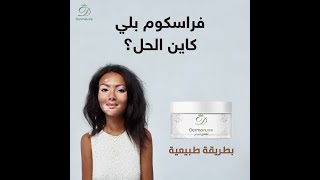 dermonuxe لعلاج البرص و البهاق