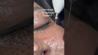 #elsalvador  #fibroblast