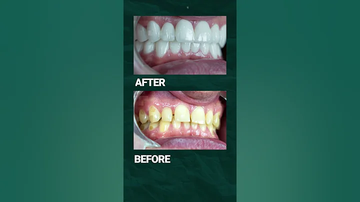 Incredible Before & After of a Smile Makeover Using Zirconia Crowns 👄