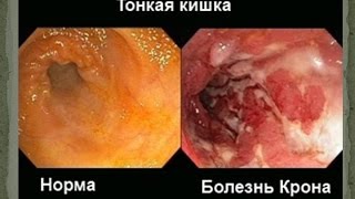 Болезнь Крона. Симптомы и лечение болезни Крона. Колит (воспаление толстого кишечника) Болезнь Крона. Симптомы и лечение болезни Крона. Колит (воспаление толстого кишечника)