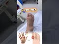 Nếu u gout không được điều trị, hậu quả sẽ thế nào | Dr Duy Cương