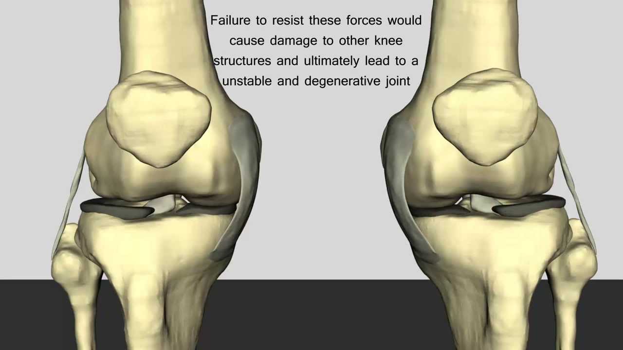 Arthroscopic picture of left knee revealing (a) bulky anterior cruciate