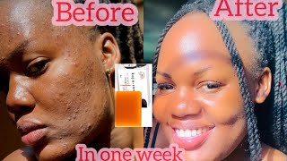 HOW TO USE KOJIC ACID SOAP *WATCH THIS BEFORE USING KOJIC ACID*