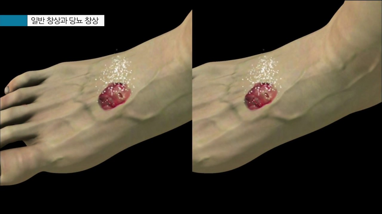 당뇨발 - 일반 창상과 당뇨 창상