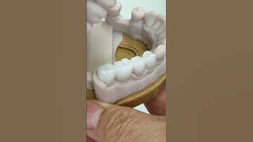 Maximize the occlusion contact