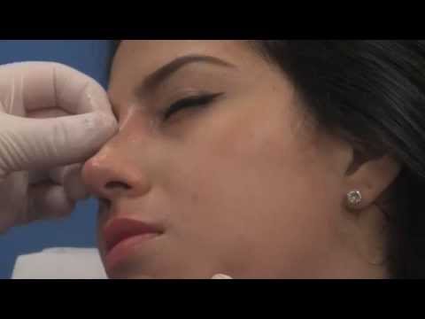 Edgewater, NJ | Non-Surgical Nose Job | The Kaplan Center