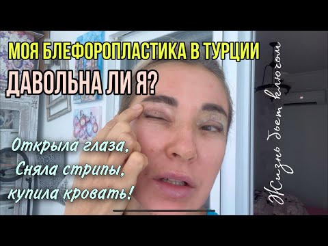 Наконец то!! Полный результат после блефаропластики в Турции. Убрала стрипы купила кровать!