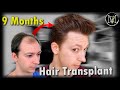 9 months after hair transplant  6500 grafts  norwood 5a