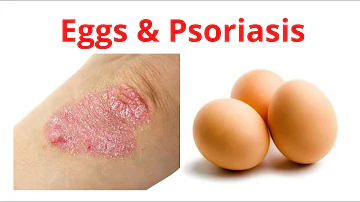 What tea is good for psoriasis?