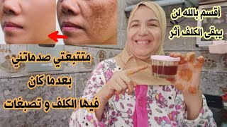 وصفة 7 أيام التي يبحت عنها الجميع لعلاج الكلف في الوجه بقع وكلف عشرين سنة ستزول في أسبوع فقط