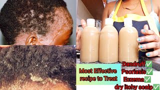 HOW TO MAKE EFFECTIVE HOMEMADE SHAMPOO; TREAT DANDRUFF, PSORIASIS,ECZEMA,DRY/ITCHY SCALP #haircare