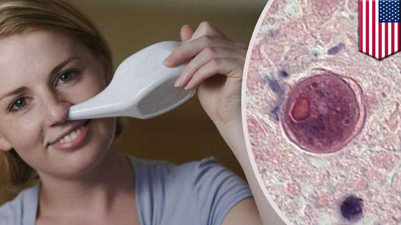 Seattle Woman Dies From Rare Amoeba After Using Neti Pot