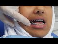 مطاط ،تقويم الاسنان ،الصنف الثالث  cClass3 ortho elastics