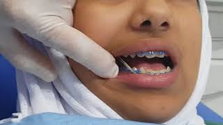 Cclass3 أورثو المطاطية يوتيوب