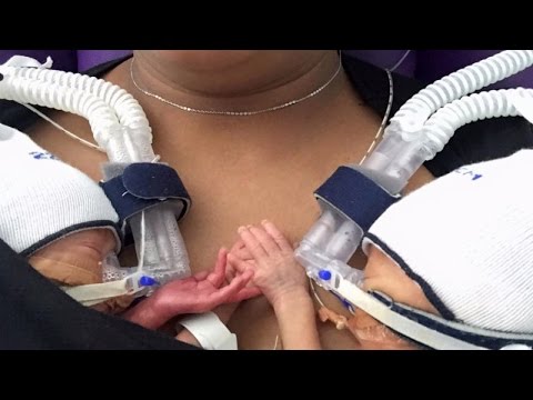 Video: Este posibil ca un geamăn să se nască prematur?