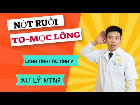 Nốt ruồi TO- MỌC LÔNG có phải ung thư không,lành tính hay ác tính, nên xử lý như thế nào/DR.NGỌC