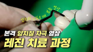 앞니 충치 레진 치료의 모든 과정 대공개‼ | “레진 치료를 했는데 치아 표면이 울퉁불퉁하다면…”