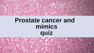 Prostate Cancers and Mimics Quiz - 10 Cases screenshot 5